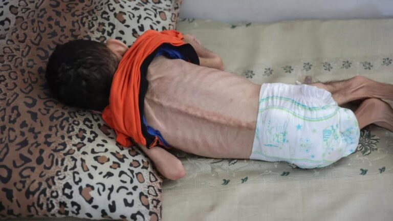 Criança palestina Jawad Al-Anqar morreu em Gaza por desnutrição, no último sábado (19/7), conforme fonte do Hospital Al-Shifa (Palestine International Broadcast)